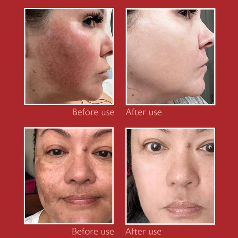 Whitening Freckle Cream Remove Dark Spots Anti Freckle Face Creams Niacinamide Fade Pigmentation Melasma Brighten Skin Care 20g