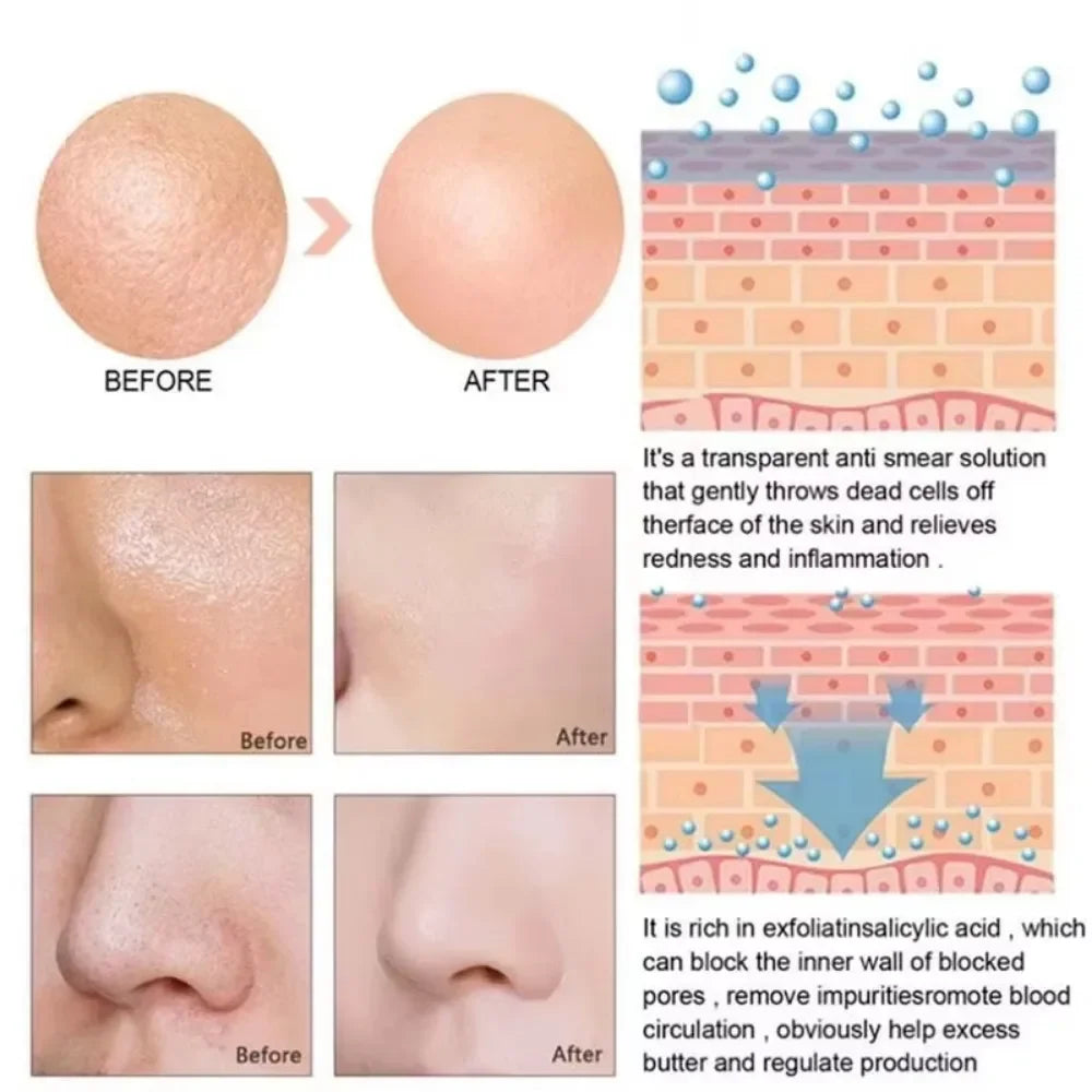 Lactic Acid Large Pores Removal Serum Pore Shrinking Minimizing Essence Moisturizing Firming Smooth Repair Korean Skin Care