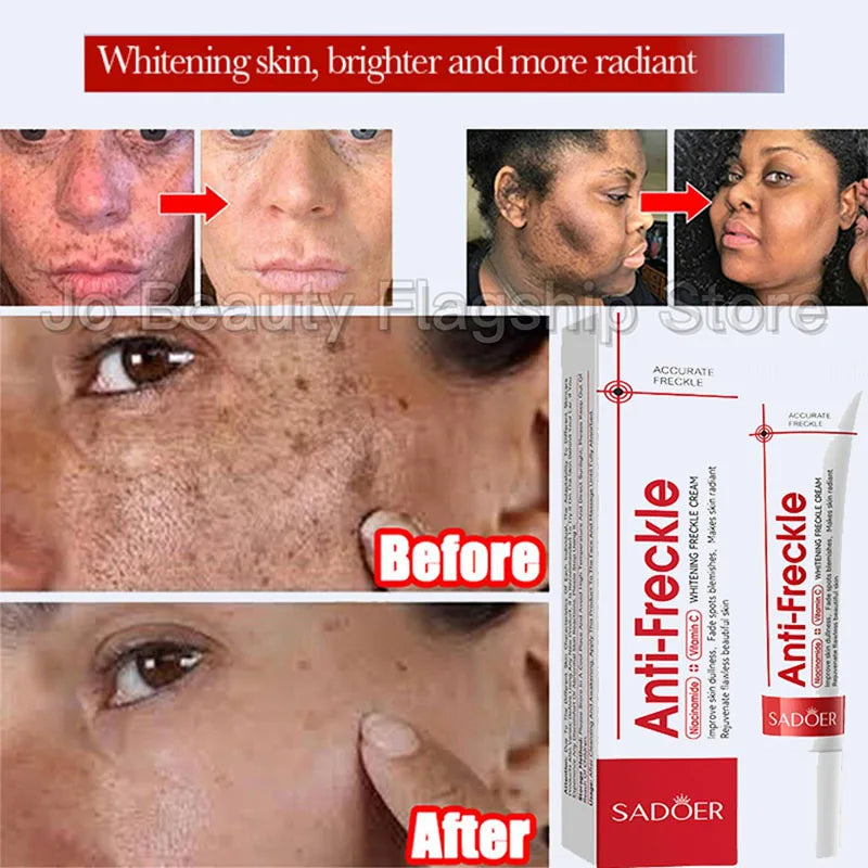 Whitening Freckle Cream Remove Dark Spots Anti Freckle Face Creams Niacinamide Fade Pigmentation Melasma Brighten Skin Care 20g